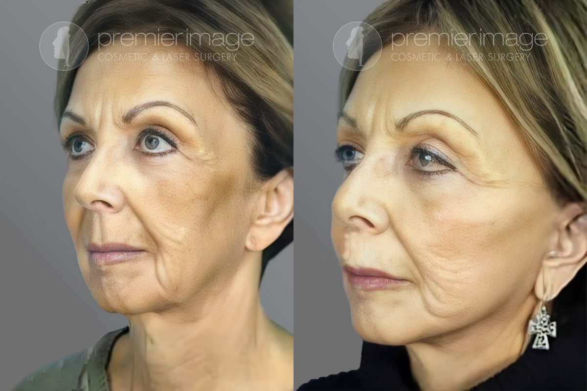 Facelift and Necklift Before and after photos in Sandy Springs, GA, Patient 16111