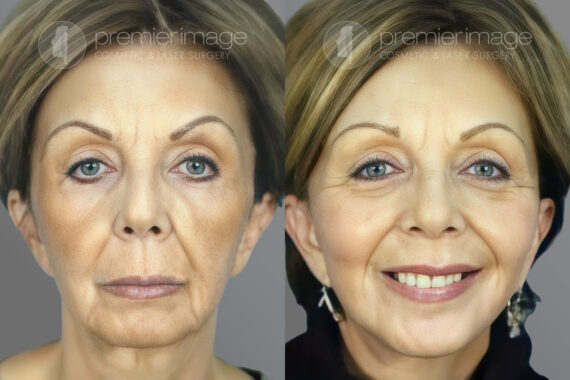 Facelift and Necklift Before and after photos in Sandy Springs, GA, Patient 16111