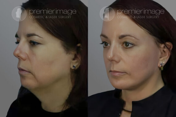 Facelift and Necklift Before and after photos in Sandy Springs, GA, Patient 16118