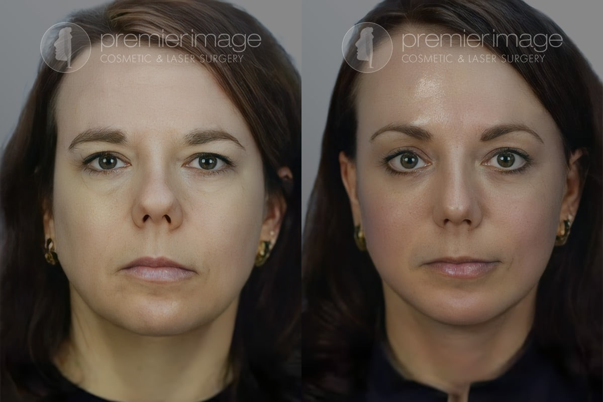 Facelift and Necklift Before and after photos in Sandy Springs, GA, Patient 16118