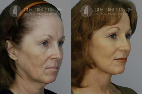 Facelift and Necklift Before and after photos in Sandy Springs, GA, Patient 16123