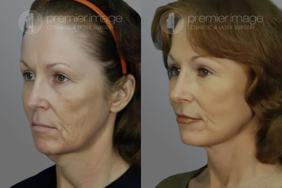 Facelift and Necklift Before and after photos in Sandy Springs, GA, Patient 16123