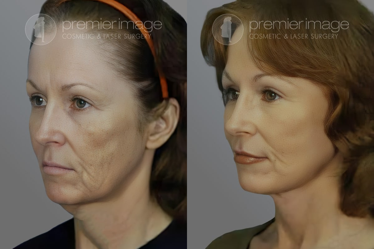 Facelift and Necklift Before and after photos in Sandy Springs, GA, Patient 16123