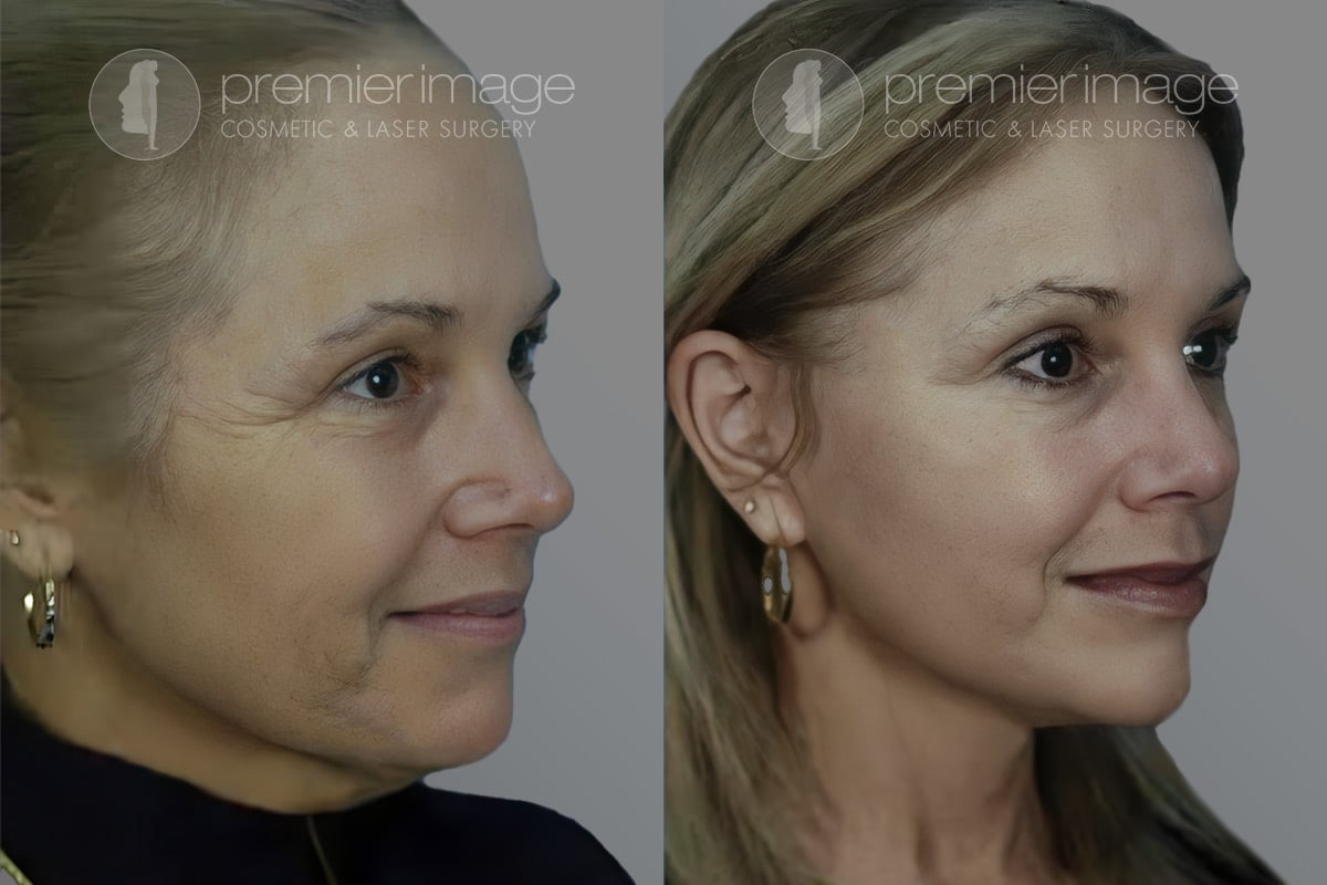 Facelift and Necklift Before and after photos in Sandy Springs, GA, Patient 16128