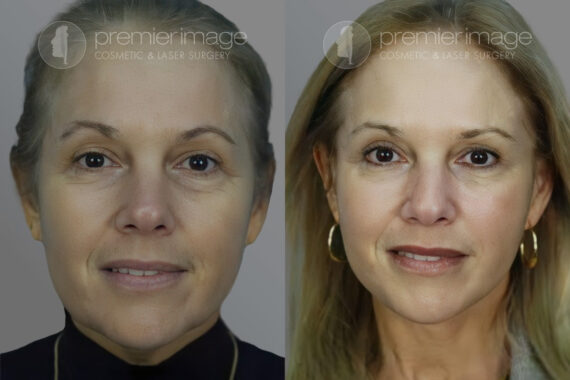 Facelift and Necklift Before and after photos in Sandy Springs, GA, Patient 16128