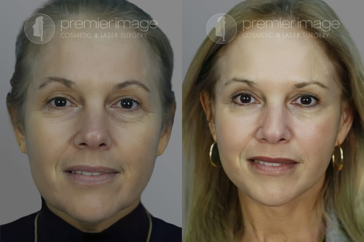 Facelift and Necklift Before and after photos in Sandy Springs, GA, Patient 16128