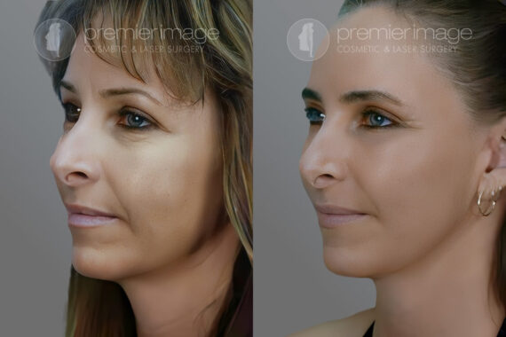 Facelift and Necklift Before and after photos in Sandy Springs, GA, Patient 16135