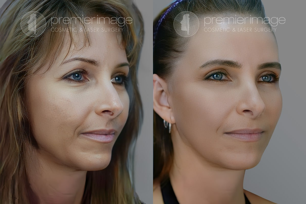 Facelift and Necklift Before and after photos in Sandy Springs, GA, Patient 16135