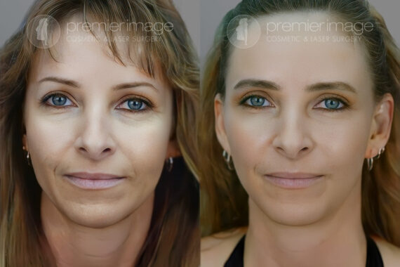 Facelift and Necklift Before and after photos in Sandy Springs, GA, Patient 16135