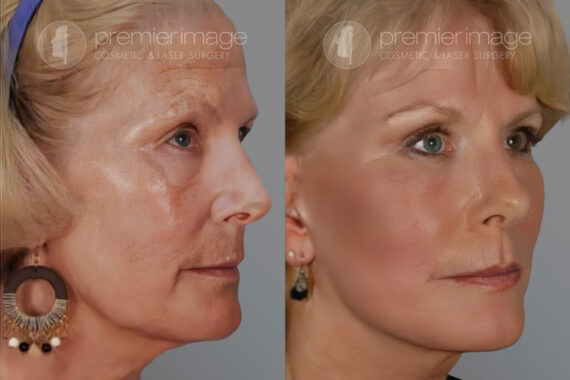Facelift and Necklift Before and after photos in Sandy Springs, GA, Patient 16142