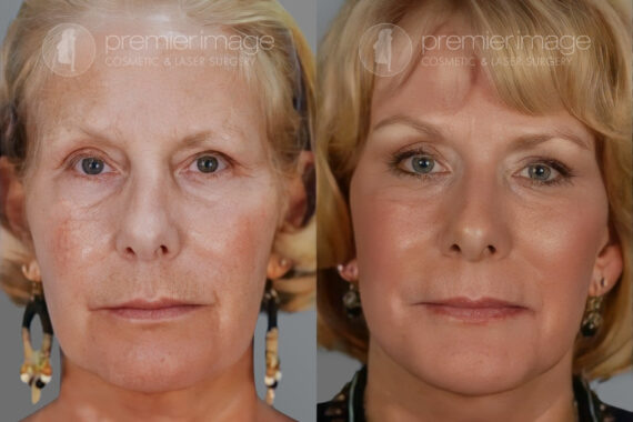 Facelift and Necklift Before and after photos in Sandy Springs, GA, Patient 16142
