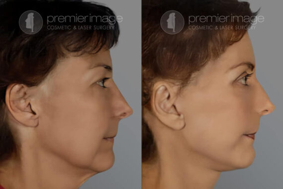 Facelift and Necklift Before and after photos in Sandy Springs, GA, Patient 16147
