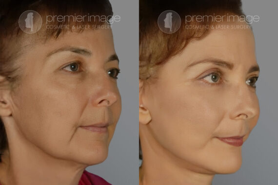 Facelift and Necklift Before and after photos in Sandy Springs, GA, Patient 16147