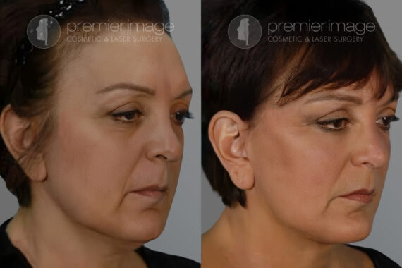 Facelift and Necklift Before and after photos in Sandy Springs, GA, Patient 16152