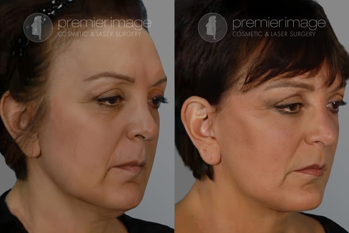 Facelift and Necklift Before and after photos in Sandy Springs, GA, Patient 16152