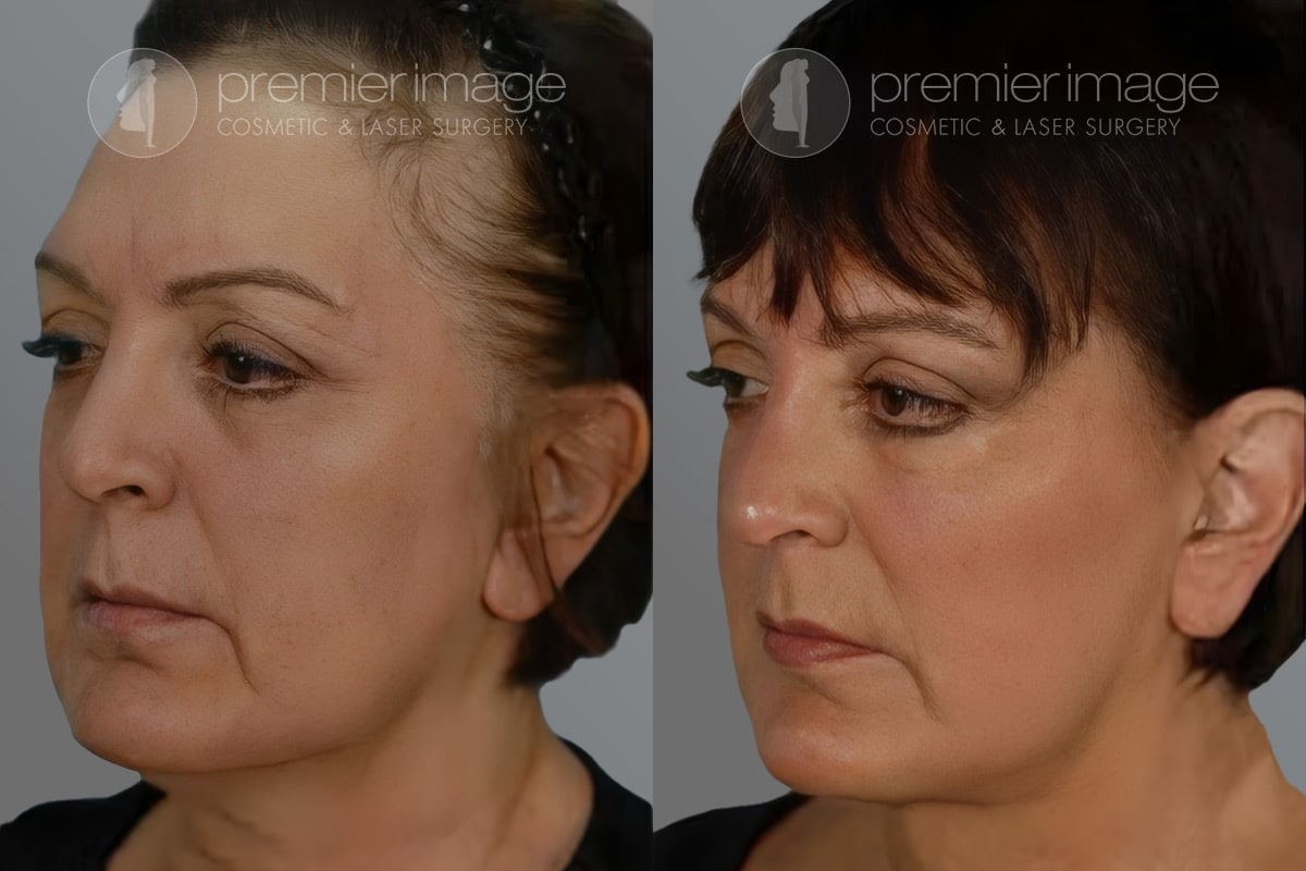 Facelift and Necklift Before and after photos in Sandy Springs, GA, Patient 16152