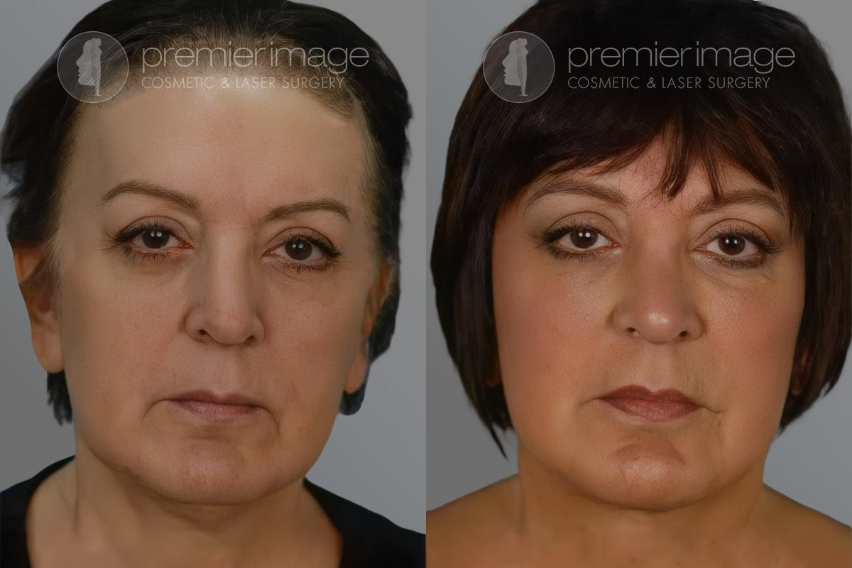 Facelift and Necklift Before and after photos in Sandy Springs, GA, Patient 16152