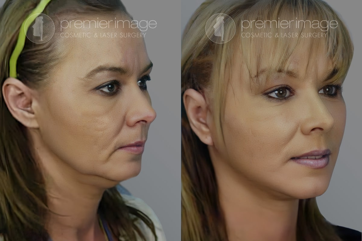 Facelift and Necklift Before and after photos in Sandy Springs, GA, Patient 16159