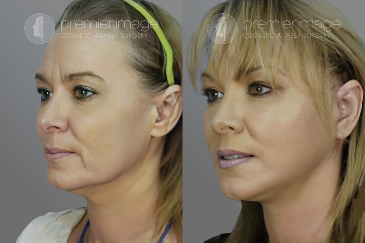 Facelift and Necklift Before and after photos in Sandy Springs, GA, Patient 16159