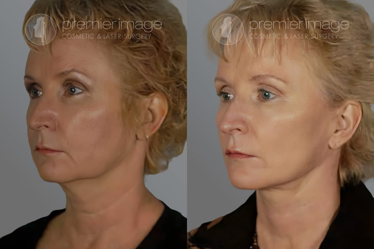 Facelift and Necklift Before and after photos in Sandy Springs, GA, Patient 16164
