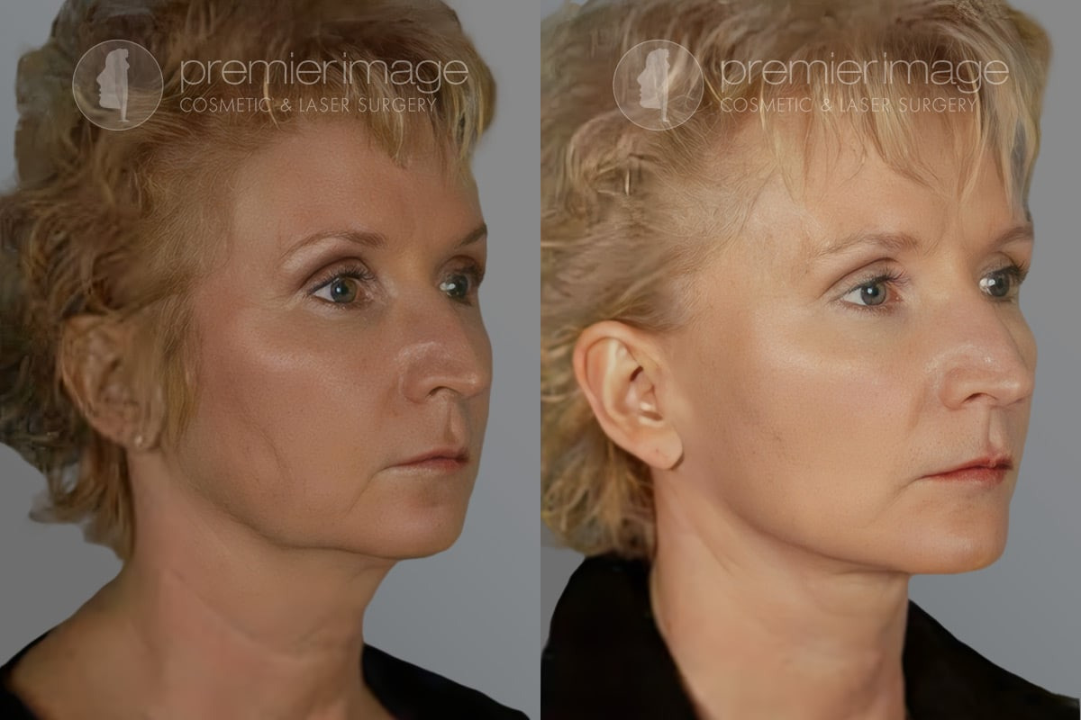Facelift and Necklift Before and after photos in Sandy Springs, GA, Patient 16164