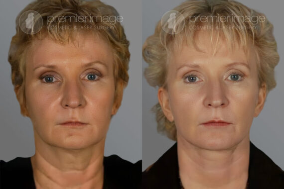 Facelift and Necklift Before and after photos in Sandy Springs, GA, Patient 16164