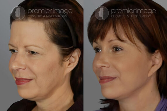 Facelift and Necklift Before and after photos in Sandy Springs, GA, Patient 16173