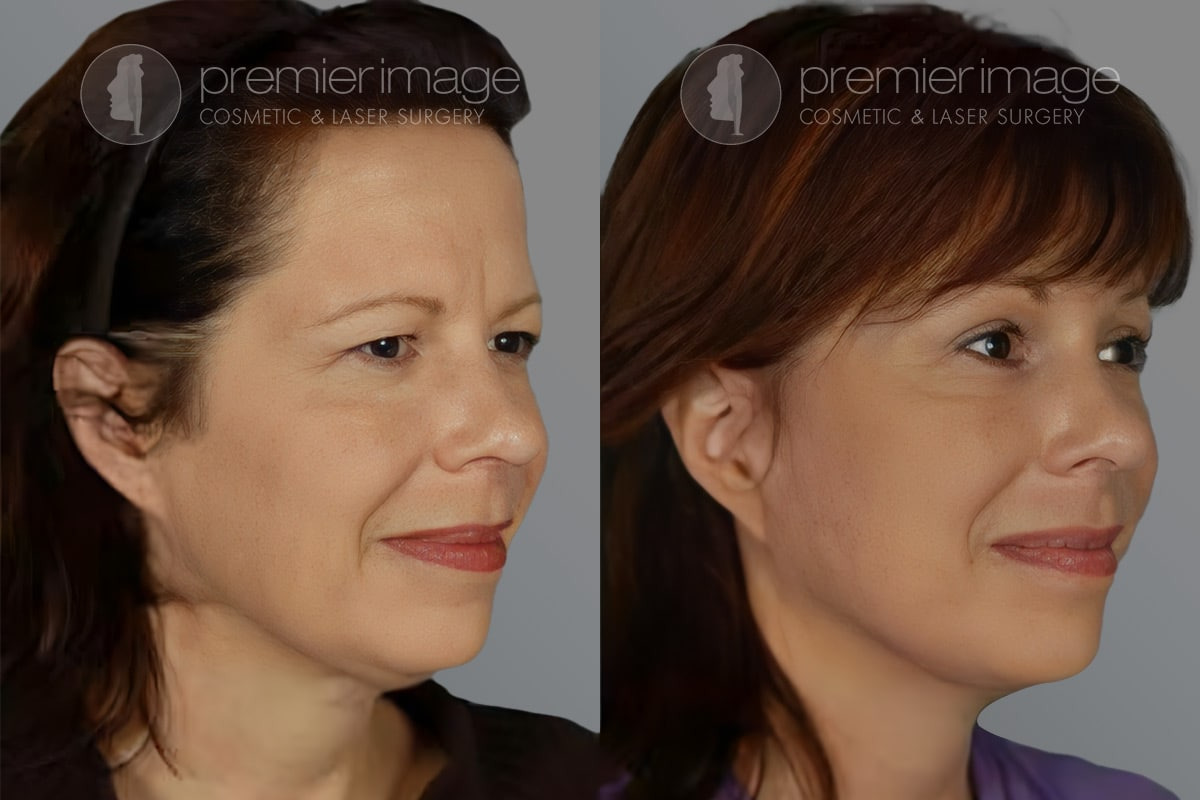 Facelift and Necklift Before and after photos in Sandy Springs, GA, Patient 16173