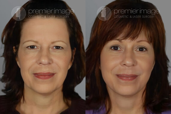 Facelift and Necklift Before and after photos in Sandy Springs, GA, Patient 16173