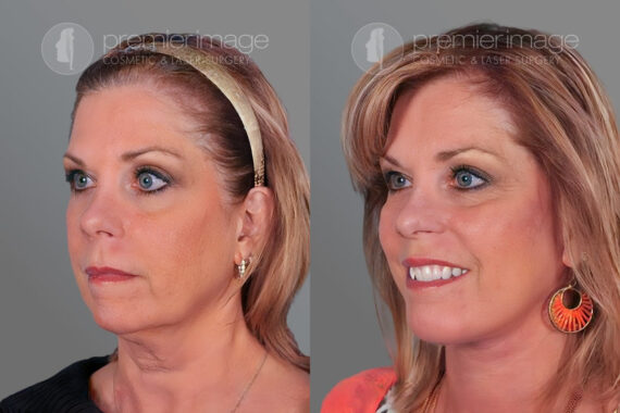 Facelift and Necklift Before and after photos in Sandy Springs, GA, Patient 16187