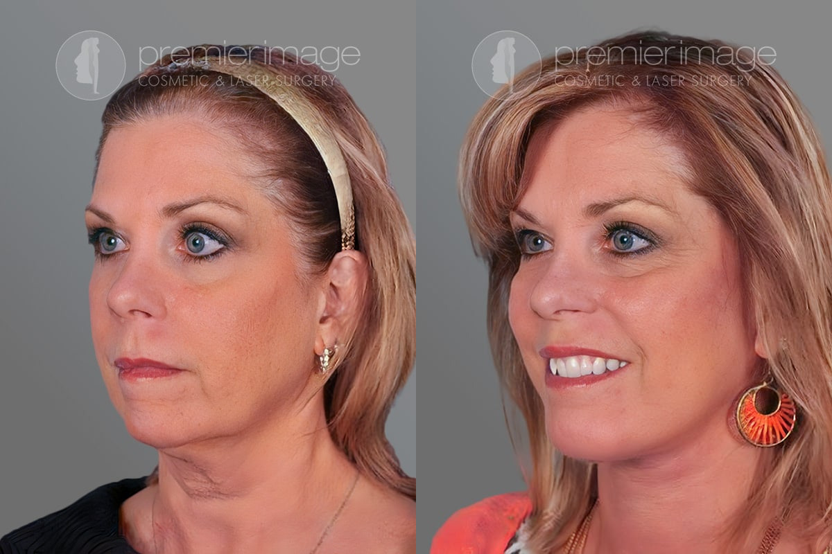 Facelift and Necklift Before and after photos in Sandy Springs, GA, Patient 16187