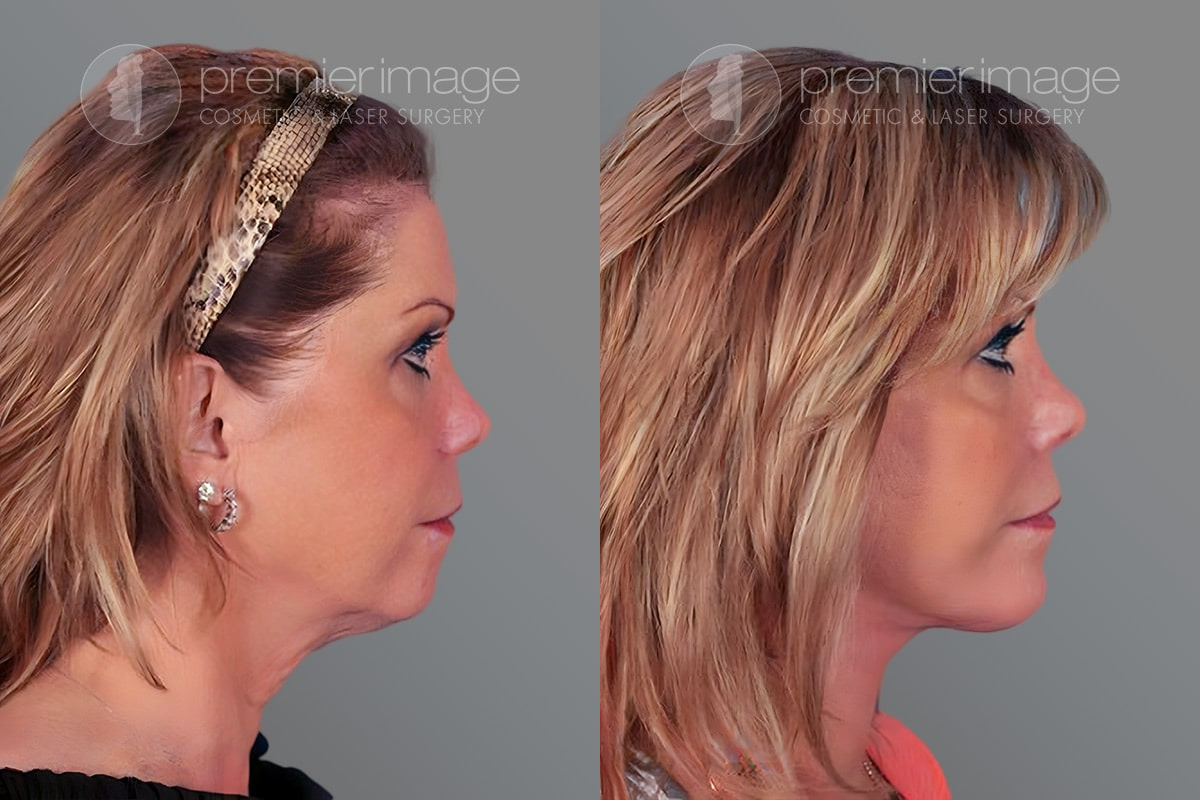 Facelift and Necklift Before and after photos in Sandy Springs, GA, Patient 16187