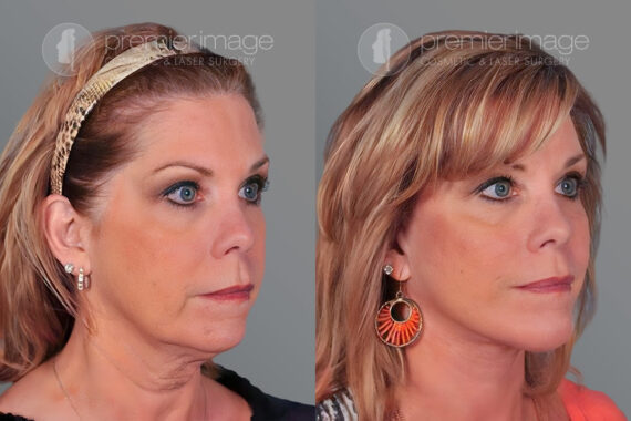 Facelift and Necklift Before and after photos in Sandy Springs, GA, Patient 16187