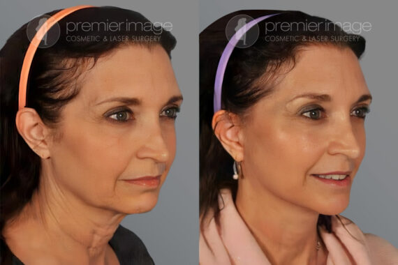 Facelift and Necklift Before and after photos in Sandy Springs, GA, Patient 16194