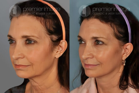 Facelift and Necklift Before and after photos in Sandy Springs, GA, Patient 16194