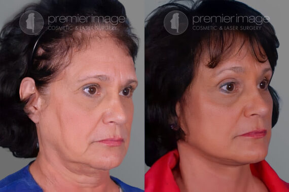 Facelift and Necklift Before and after photos in Sandy Springs, GA, Patient 16199
