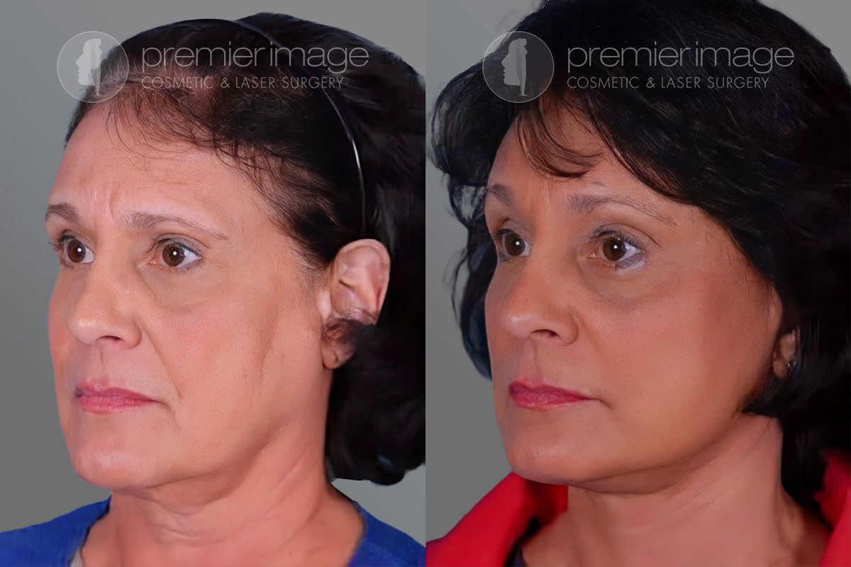 Facelift and Necklift Before and after photos in Sandy Springs, GA, Patient 16199