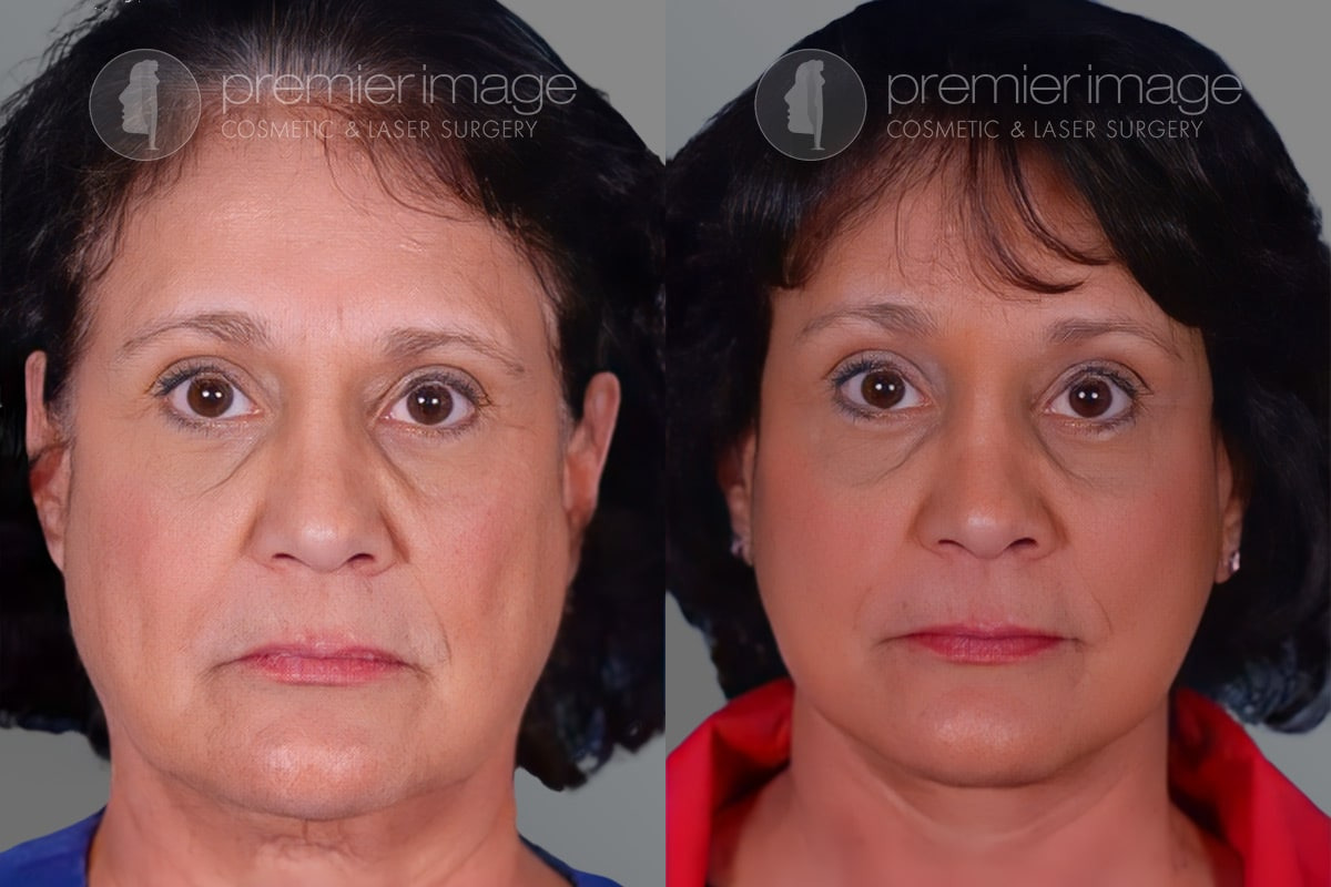 Facelift and Necklift Before and after photos in Sandy Springs, GA, Patient 16199