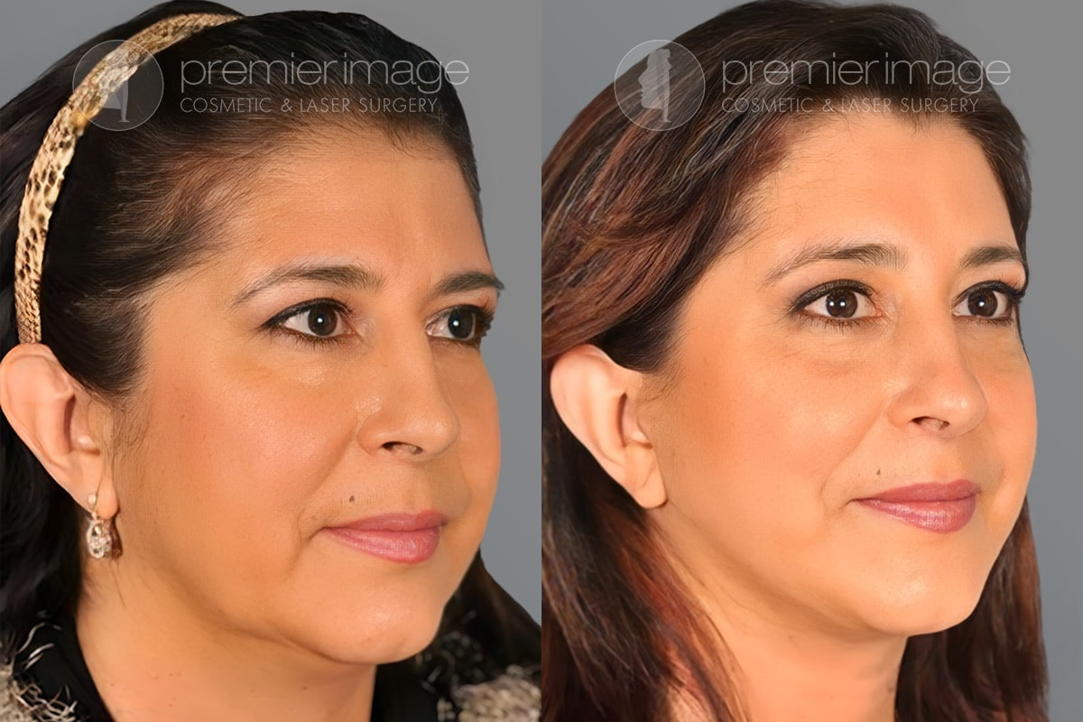 Facelift and Necklift Before and after photos in Sandy Springs, GA, Patient 16208