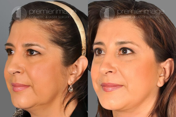 Facelift and Necklift Before and after photos in Sandy Springs, GA, Patient 16208