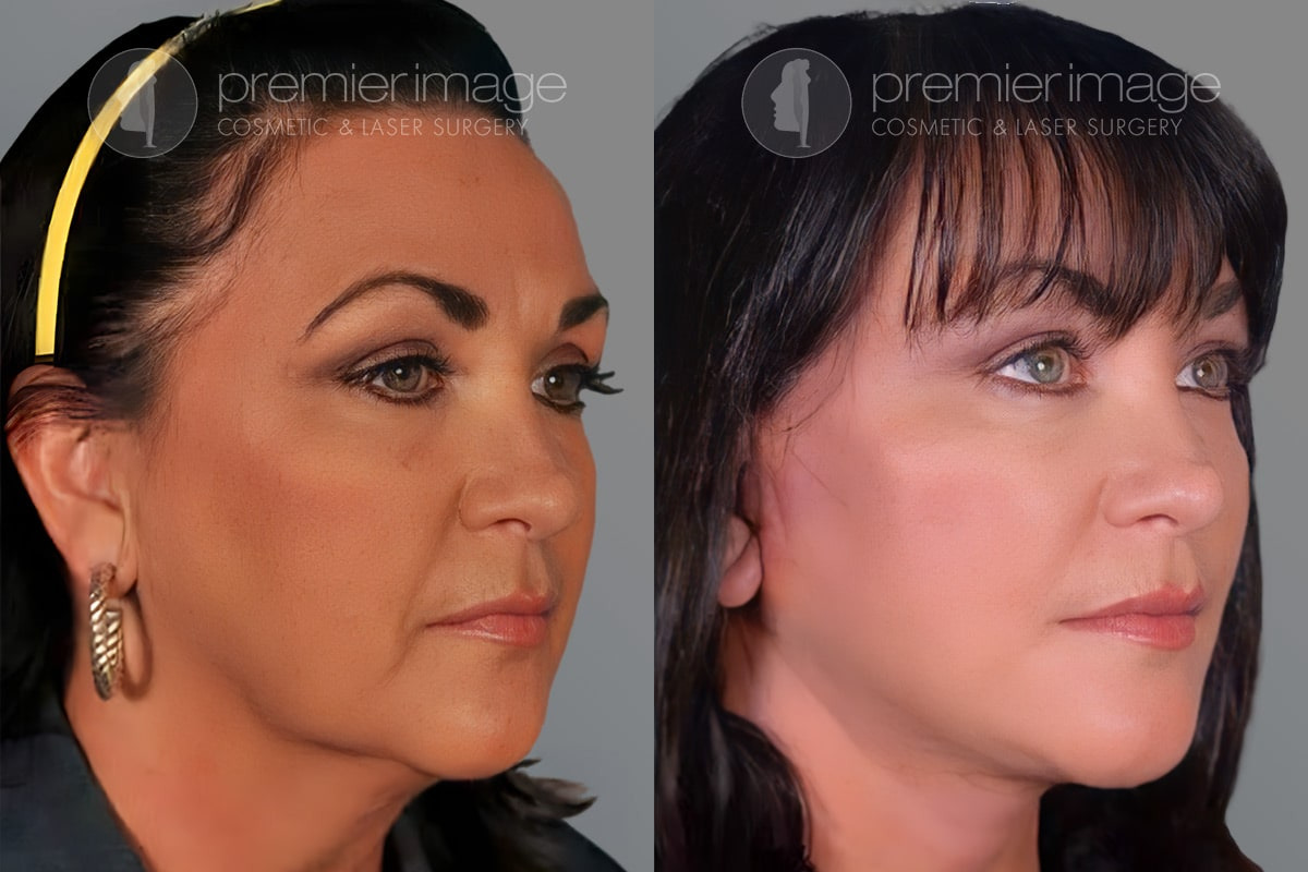 Facelift and Necklift Before and after photos in Sandy Springs, GA, Patient 16213