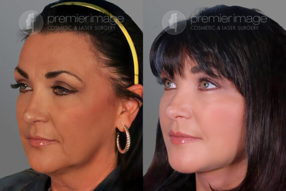 Facelift and Necklift Before and after photos in Sandy Springs, GA, Patient 16213