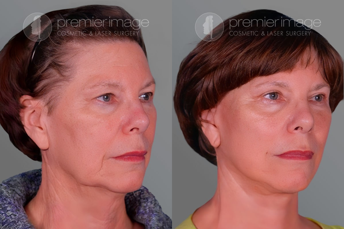 Facelift and Necklift Before and after photos in Sandy Springs, GA, Patient 16223