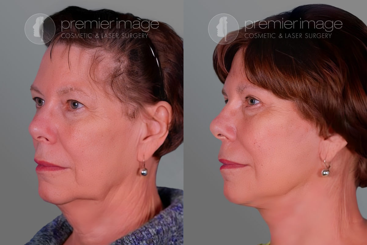 Facelift and Necklift Before and after photos in Sandy Springs, GA, Patient 16223