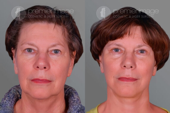 Facelift and Necklift Before and after photos in Sandy Springs, GA, Patient 16223