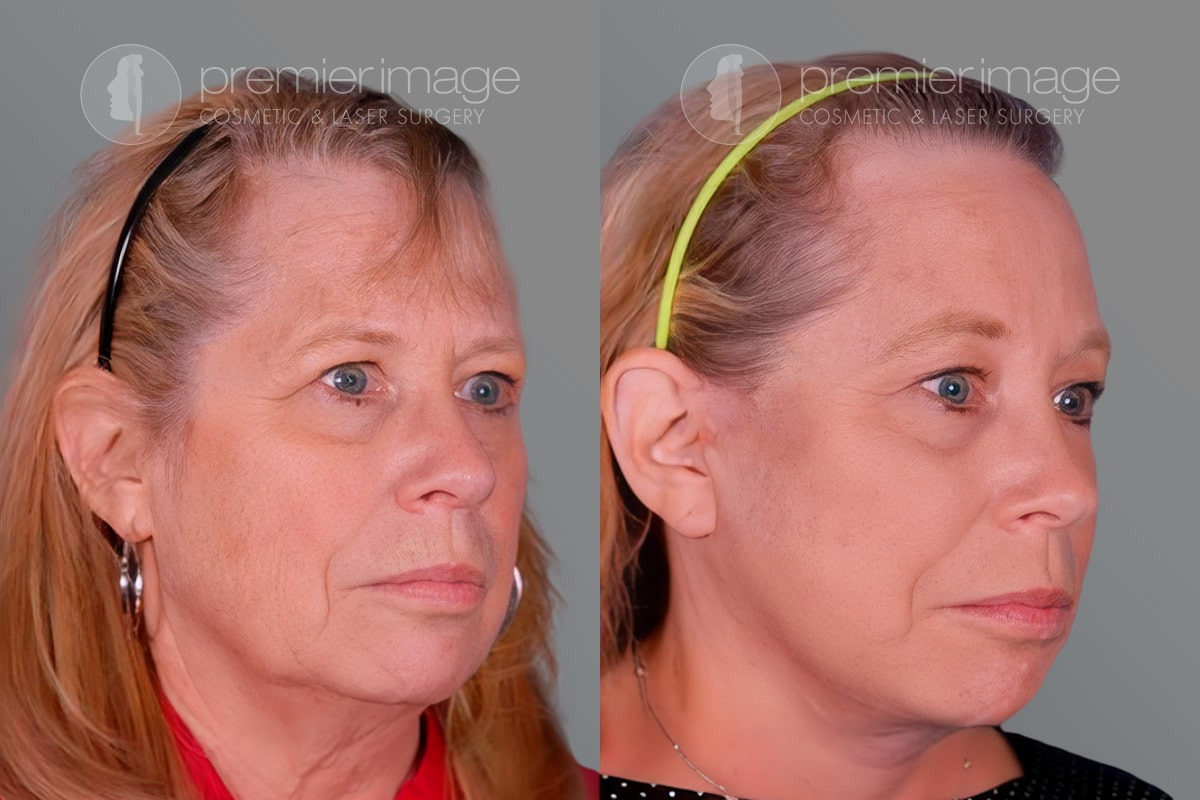 Facelift and Necklift Before and after photos in Sandy Springs, GA, Patient 16230