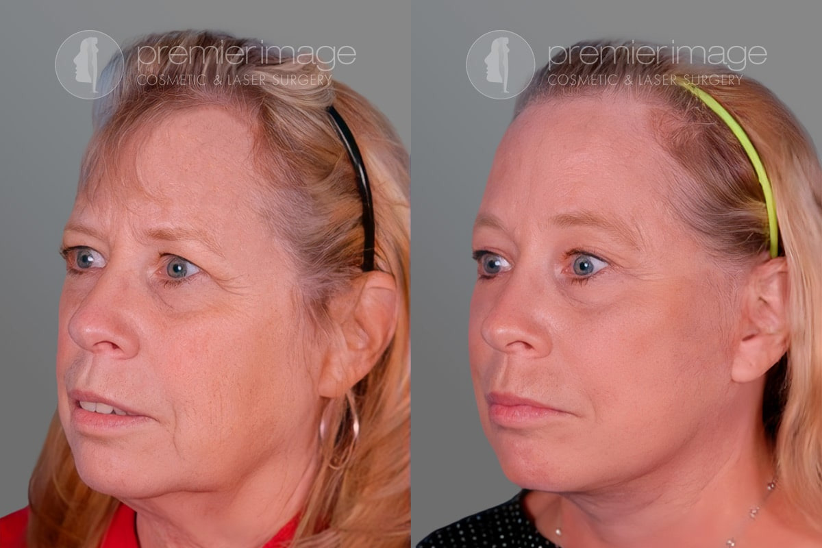 Facelift and Necklift Before and after photos in Sandy Springs, GA, Patient 16230