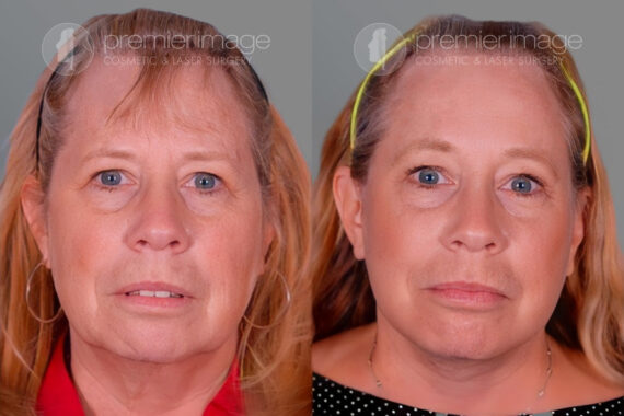 Facelift and Necklift Before and after photos in Sandy Springs, GA, Patient 16230