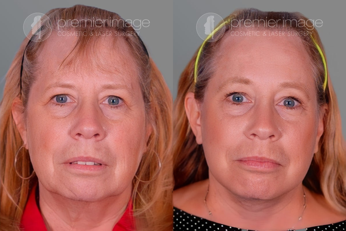 Facelift and Necklift Before and after photos in Sandy Springs, GA, Patient 16230