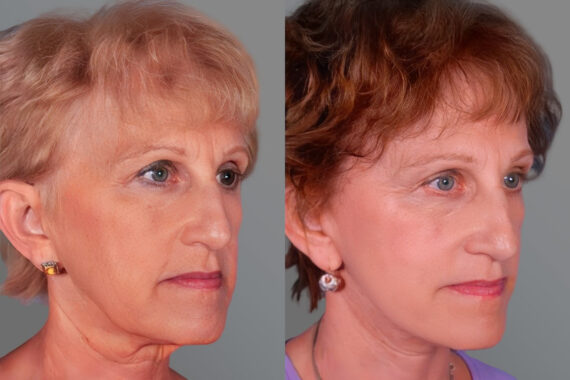 Facelift and Necklift Before and after photos in Sandy Springs, GA, Patient 16237